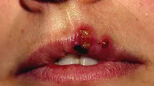 ps on lips causes treatmentore