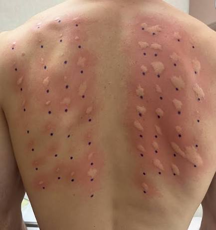 In my fun time getting tested for an allergy test last week, I tested positive for EVERYTHING they tested me on. Including dogs (not very much) but cats, all grasses, all trees,