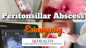 peritonsillar abscess emergency and
