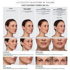 juvederm dermatology ociates of