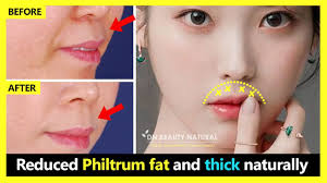 protruding philtrum thick upper lip