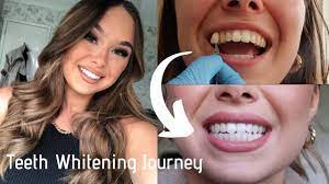 my teeth whitening journey during