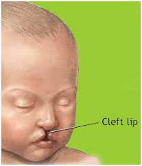 cleft lip surgery cleft lip surgery