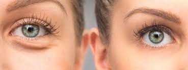 surrey eye circles bags treatments
