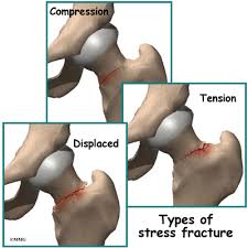 stress fracture of the hip eorthopod com