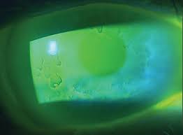 Corneal dystrophy, anterior basement membrane; When Dry Eye Disease Is A Secondary Condition