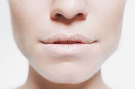 getting chapped lips in summers