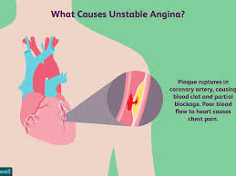 Unstable angina (ua), also called crescendo angina, is a type of angina pectoris that is irregular. Unstable Angina Overview And More