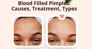 blood filled pimples causes treatment