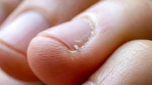 hangnail causes symptoms and treatment
