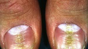 ridges in fingernails symptoms causes