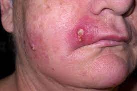 staph infection symptoms causes