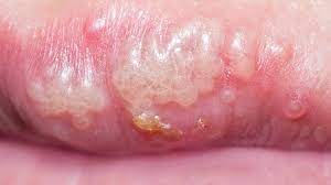 hiv mouth sores what they look like