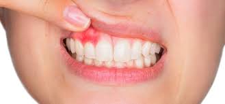 how to manage early se gum disease