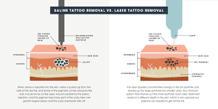 saline tattoo removal vs laser tattoo