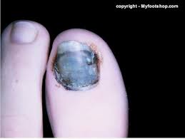toe nail injuries causes and