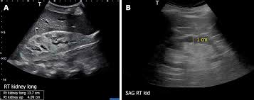Point Of Care Renal Ultrasonography For The Busy