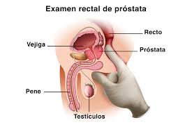 Cómo detectar el cáncer de próstata a tiempo | Cirugía Robótica San Rafael