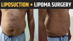 liposuction and multiple lipoma removal