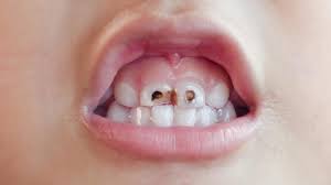 His front teeth were gapped and small. Space Between Teeth How Much Time Does It Take To Fill The Gap Practo Consult