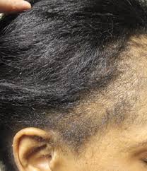 I'm not advocating that anyone try this or that this even works. Dr Donovan S Hair Loss Articles 2011 2021 Donovan Hair Clinic