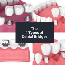the 4 types of dental bridges