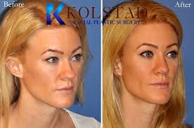 wide tip rhinoplasty results dr