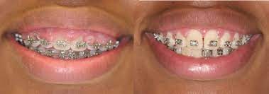 gum swelling due to braces