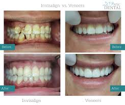 Here's how to choose between dental bonding or invisalign. Invisalign Vs Veneers Everything You Need To Know 209 Nyc Dental