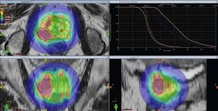 imaging for radiotherapy planning