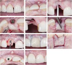 plastic periodontal and implant surgery