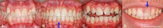 Si une dent bouge très légèrement, une simple surveillance suffira. Traumatismes Dentaires Et Orthodontie Bucco