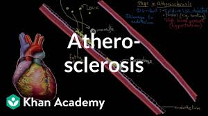 Atherosclerosis Video Khan Academy