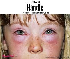 how to handle an allergic reaction call