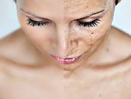 what to do after a microdermabrasion