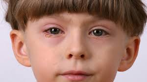 what is pink eye causes symptoms and