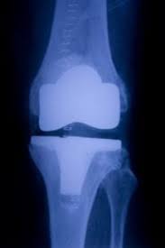 depuy synthes attune knee replacement