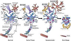 als a disease of motor neurons and