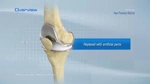 total knee replacement video cal