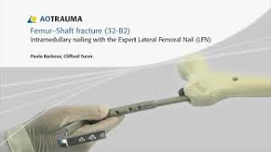 femur shaft fracture 32b2
