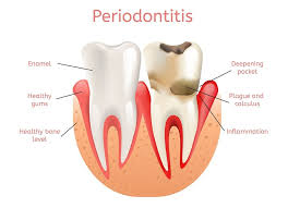 gum disease periodonis treatments