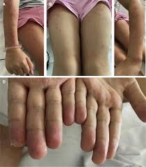Children tend to have abdominal symptoms and skin changes or rashes. Giant Urticaria And Acral Peeling In A Child With Coronavirus Disease 2019 The Journal Of Pediatrics