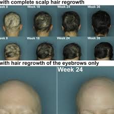 hair regrowth with abatacept treatment