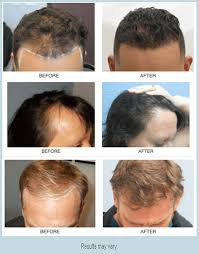 hair transplant surgery what to expect