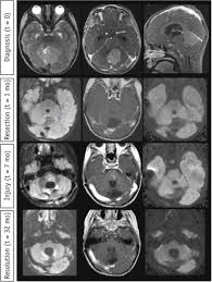 brainstem injury in pediatric patients