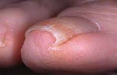 ingrown nail wart treatments archives