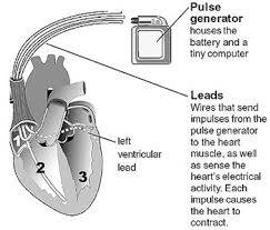 The main difference is that if. Biventricular Pacemaker