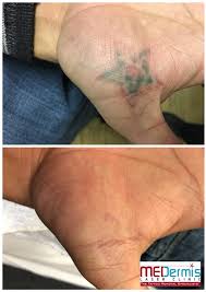 Again, depending on the size, location and type of tattoo being removed, you may need only a few sessions or several. Arms Hands Laser Tattoo Removal Before After Results Medermis