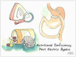 malnutrition gastric byp