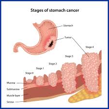 what is stomach cancer kaizen